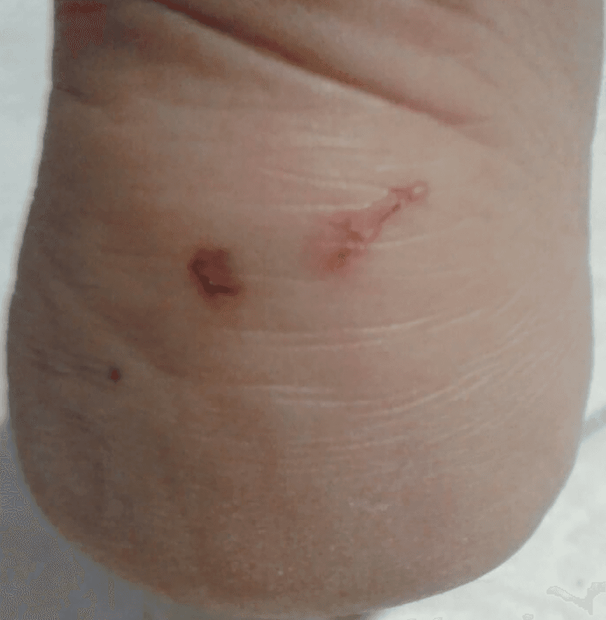 تظهر الصورة جرحًا عميقًا ومفتوحًا من عضة فأر، مما يزيد من خطر العدوى البكتيرية وحمى عضة الفأر والكزاز. قد تسبب العضة أيضًا تلفًا دائمًا للأنسجة. يجب تطهير الجرح فورًا والتوجه للطبيب لتلقي العلاج المناسب. اتصل بنا للقضاء على القوارض وتجنب المخاطر.